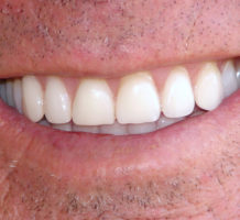 Can healthy gums prevent Alzheimer’s?