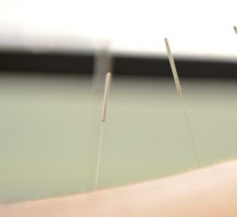 Back pain? Acupuncture study may help