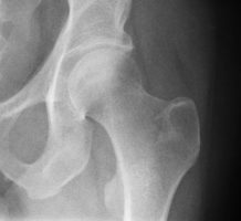 Seeking to improve hip fracture recovery