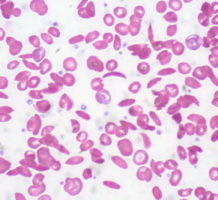 Editing genes may end sickle cell disease
