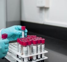 Blood test for Alzheimer’s now available