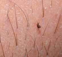 What to know about ticks, Lyme disease